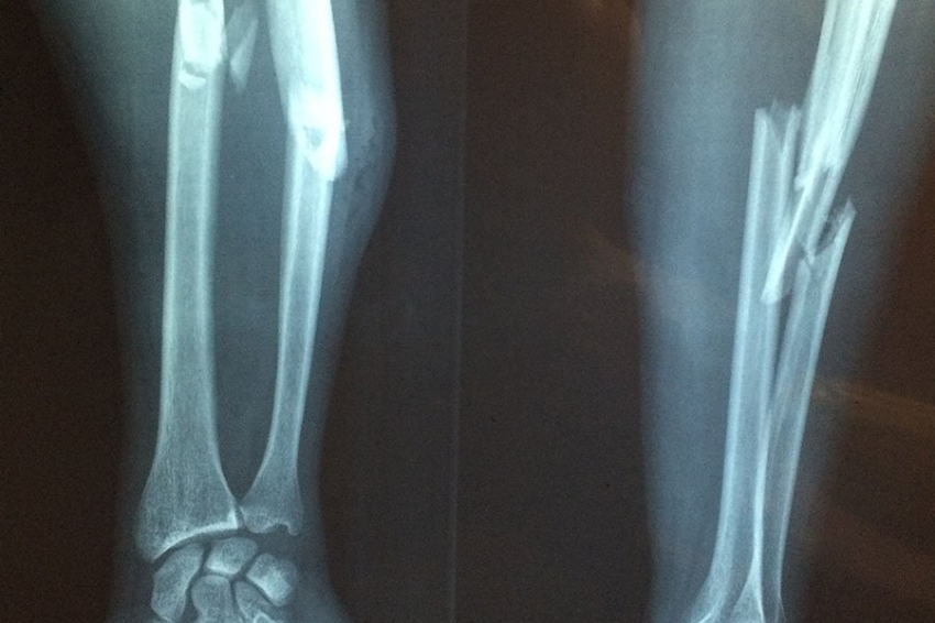 Микробиота кишечника связана с риском переломов