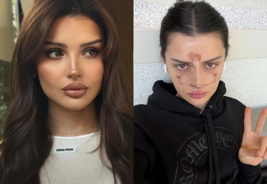 Дина Саева перенесла операцию на носу